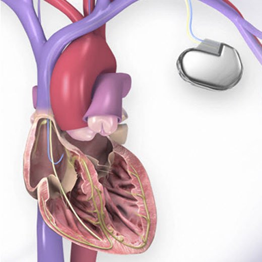 aicd-implantation-doctor