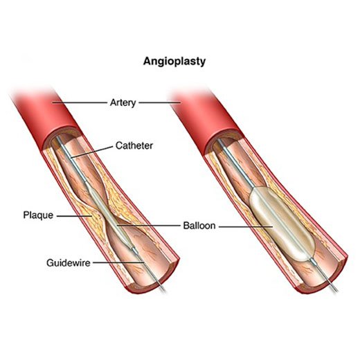 coronary-angioplasty-doctor-in-max-hospital-vaishali